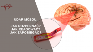 Read more about the article Udar mózgu: Jak rozpoznać, jak reagować, jak zapobiegać?