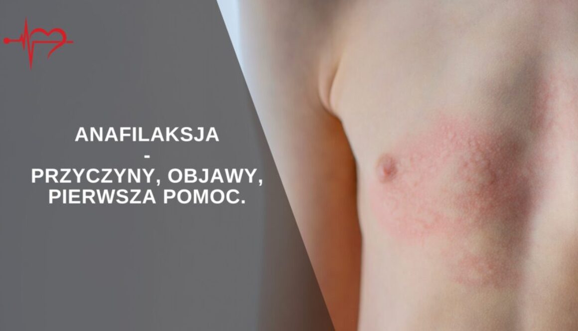 anafilaksja-1024x576-1
