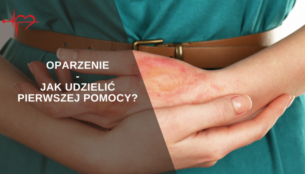 oparzenie-1-1024x576-1